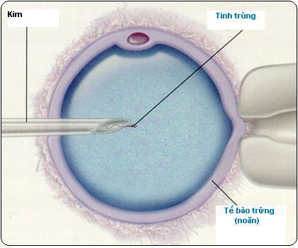 Phân biệt thụ tinh nhân tạo và thụ tinh trong ống nghiệm